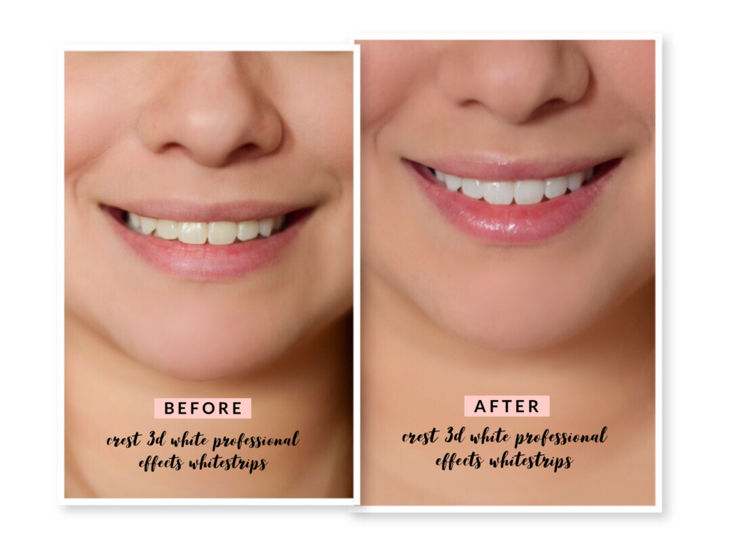 crest teeth whitening strips before and after